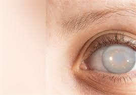 آب مروارید چه علائمی دارد؟