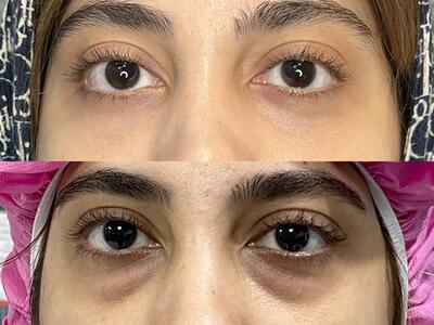 علل و روش افتادگی پلک