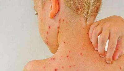 آبله مرغان برای چه افرادی خطرناک است؟/ عوارض احتمالی آبله مرغان - آینه فردا