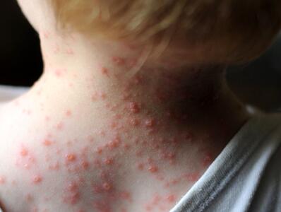 خطرات ابتلا به آبله مرغان برای این افراد
