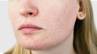 علت اصلی زبری و پوسته پوسته شدن پوست چیست؟ - سبک ایده آل
