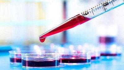 تشخیص آلزایمر با یک آزمایش ساده