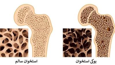 ساده‌ترین راه حل‌ها برای پیشگیری از پوکی استخوان