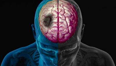 پزشک مغز و اعصاب: سکته مغزی فقط مختص سالمندان نیست