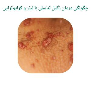 چگونگی درمان زگیل تناسلی با لیزر و کرایوتراپی
