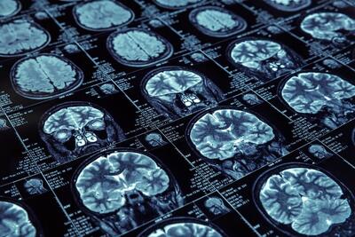 تشخیص موارد نرمال و غیرنرمال تومور از تصاویر MRI ممکن می شود تشخیص موارد نرمال و غیرنرمال تومور از تصاویر MRI ممکن می شود