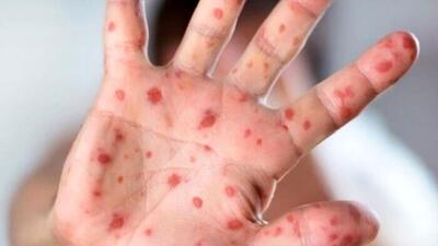 زنگ خطر شیوع بیماری کشنده در یزد به صدا درآمد