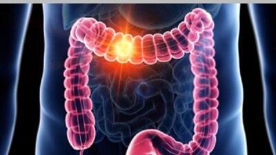 سرطان روده: علائم، پیشگیری و اهمیت تشخیص زودهنگام