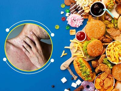باید ها و نباید های تغذیه ای در هنگام ابتلا به آبله مرغان را جدی بگیرید