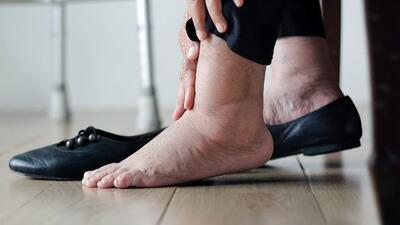 آیا تورم پا به خستگی محدود می‌شود یا زنگ خطری برای قلب است؟
