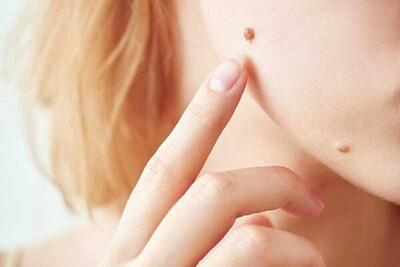 علائم خال های سرطانی