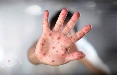 سرخک از مرزها می‌آید؛ هشدار وزارت بهداشت درباره اتباع واکسینه‌ نشده