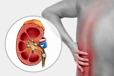 چه چیزهایی باعث سنگ ساز شدن کلیه ها می شود؟