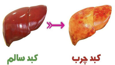 چه کسانی در معرض ابتلا به بیماری کبد چرب هستند؟