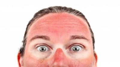 چند توصیه مفید برای رهایی از آفتاب سوختگی