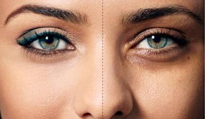 تیرگی و سیاهی زیر چشم چگونه از بین می رود؟