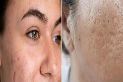 بهترین کرم برا از بین بردن جای جوش و لک های تیره و قهوه ای صورت/ پوستی شفاف و آینه ای