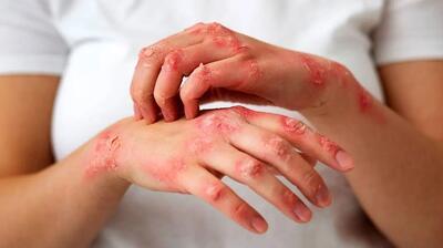 خبر مهم معاون وزارت بهداشت از ماجرای گسترش جذام در میان اتباع - آینه فردا