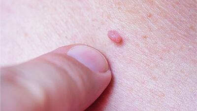 چرا باید HPV را جدی بگیریم؟ | چه کسانی باید واکسن بزنند؟