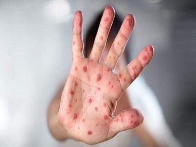 ثبت تاکنون ۴ مورد ابتلا به سرخک در یزد/تردد در واکسیناسیون عامل طغیان سرخک