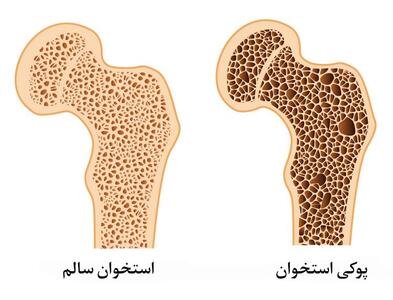 آیا پوکی استخوان درمان دارد؟