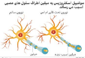میگنا - ۹ علامت که از ابتلا به «ام اس» خبر می‌دهد