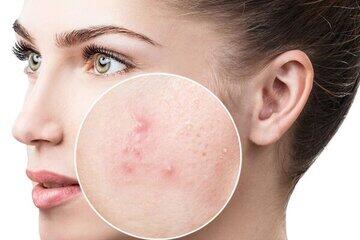 چرا صورتمون جوش میزنه؟+فیلم - سبک ایده آل