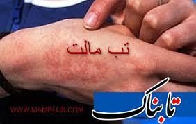با رعایت این نکات از تب مالت در امان بمانید
