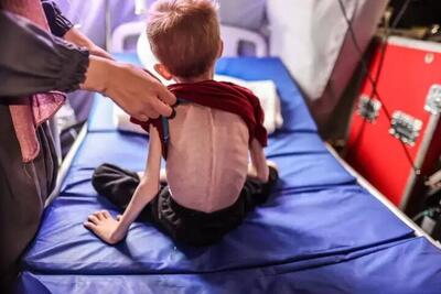 دولت غزه: ۶۵ هزار کودک غزه دچار سوء تغذیه حاد هستند