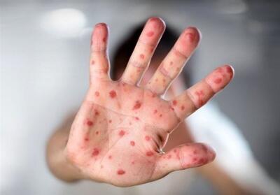 هشدار درباره بازگشت سرخک؛ خطرناک اما قابل پیشگیری - تسنیم