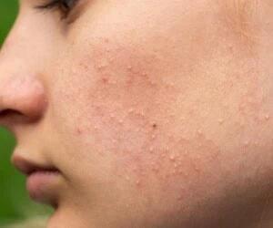 ماسک های بی نظیر خانگی ساده برای پوست نوجوانان