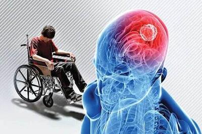 این تغییر در چشم‌ها نشانه‌ «ام اس» است