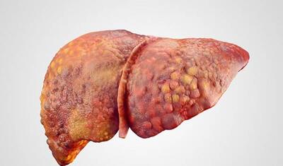 هپاتیت چه علائمی دارد و انواع مختلف آن چیست؟
