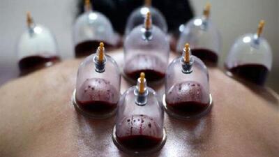 چون و چرای حجامت؛ بایدها و نبایدهای یک روش درمانی طب ایرانی