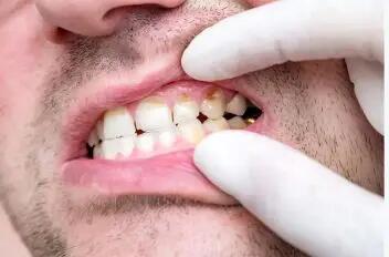 کمبود ویتامین A سبب پوسیدگی دندان میشود؟