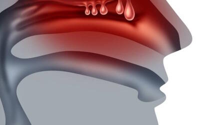 همه چیز درباره پولیپ بینی از تشخیص تا درمان و عوارض