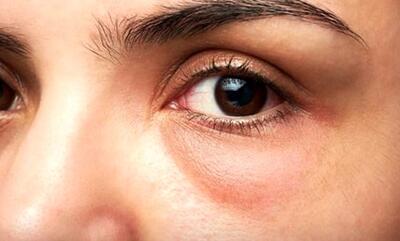 علل پف صبحگاهی چشمان چیست؟