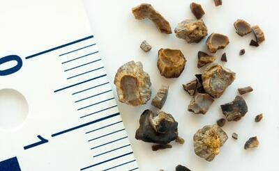احتمال ابتلای ۶.۶ درصدی جمعیت به سنگ کلیه