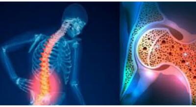 سنجش تراکم استخوان مهم ترین روش برای تشخیص و ارزیابی تراکم استخوان