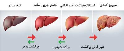 علائم و نشانه‌های ظاهری و بالینی بیماری کبد چرب را بشناسید