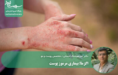 اگزما؛ بیماری مرموز پوست