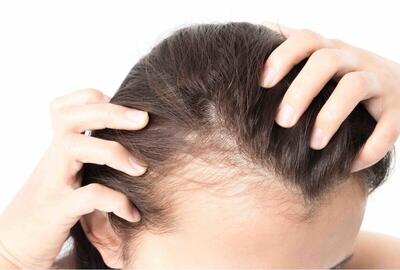 چند باور نادرست درباره ریزش مو/ درمان‌های طبیعی برای ریزش مو چقدر موثرند؟