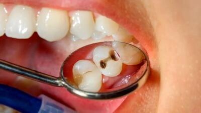 چگونه از 5 اشتباه رایج پوسیدگی دندان جلوگیری کنیم؟