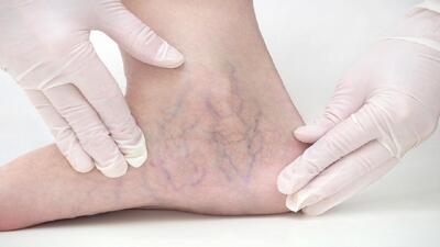 علائم اولیه واریس را بشناسید
