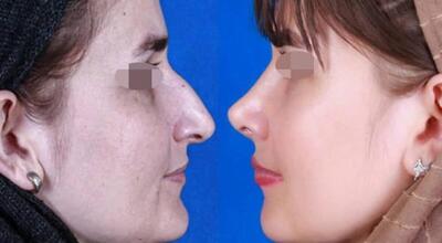 هزینه عمل بینی در سال ۱۴۰۴ / با چند میلیون می‌توانیم عمل بینی انجام دهیم؟