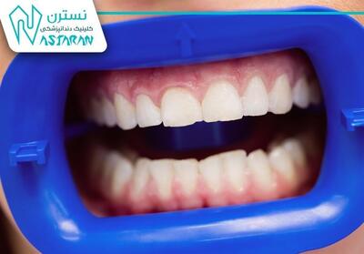 عفونت‌های لثه و پیامدهای انتخاب نادرست خدمات دندانپزشکی - تسنیم