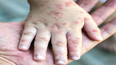 افزایش موارد مشکوک به سرخک در دزفول