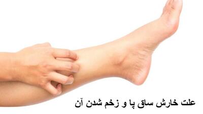 علت خارش ساق پا و زخم شدن آن چیست؟ درمان خانگی خارش ساق پا