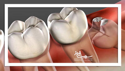 دندان عقل بی فایده یا ارزشمند؟