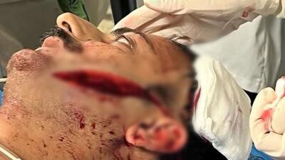 قمه‌کشی اراذل صورت مرد ۳۷ ساله را فلج کرد